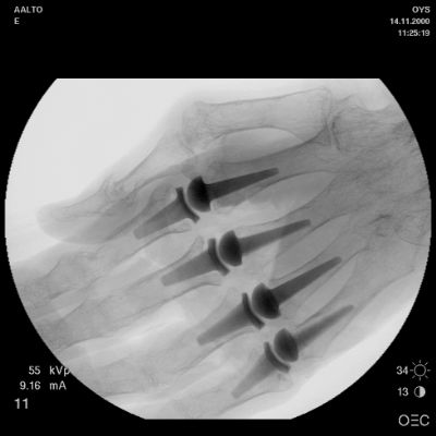 Ascension MCP Prosthesis (Implant 65)